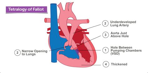 Diagram of Tetralogy of Fallot