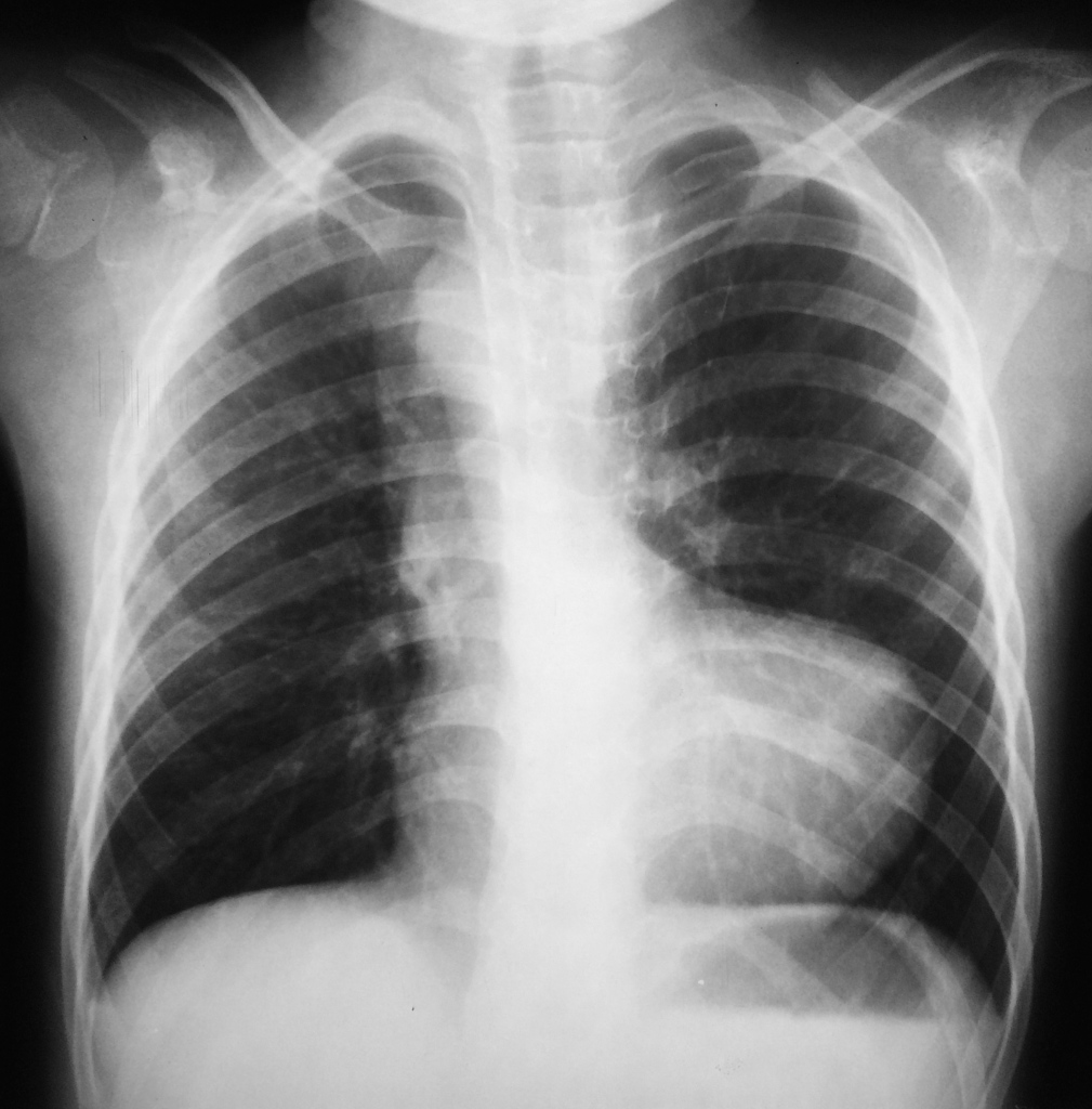 CXR and ECG of TOF
