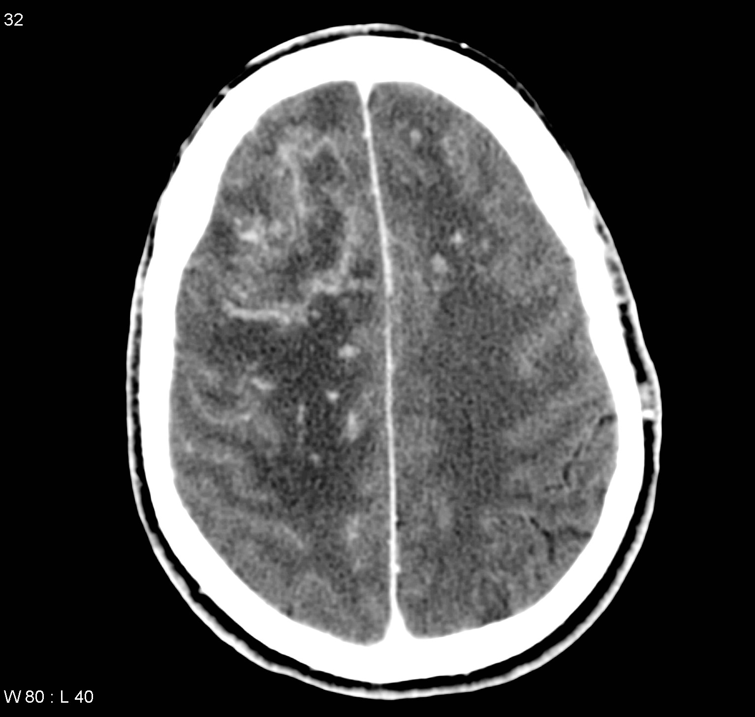 Toxoplasma brain 1
