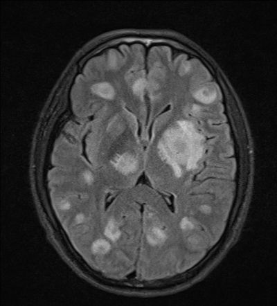 Toxoplasma brain 2