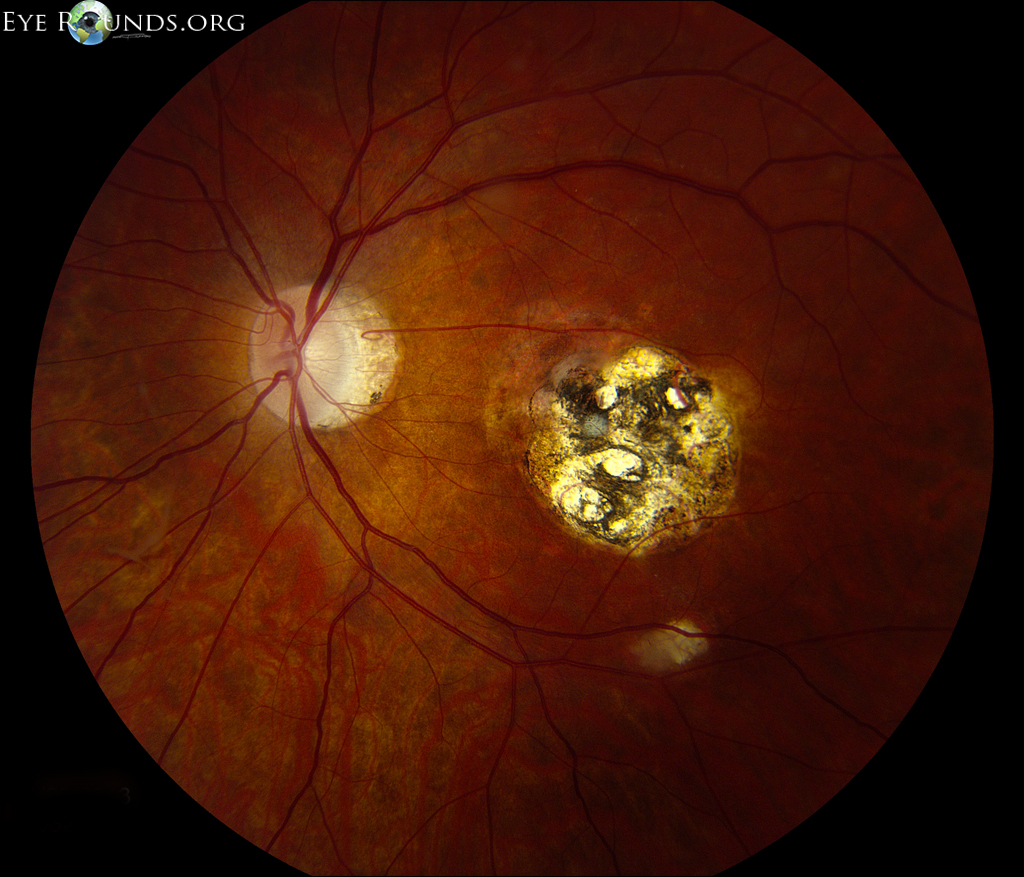 Toxoplasma eye