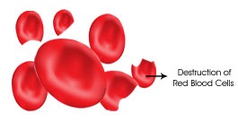Haemolysis in Wilson's Disease