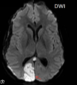 PCA infarct imaging example
