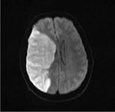 High MCA cortical stroke example