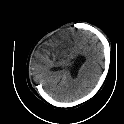 Post decompressive hemicraniectomy CT
