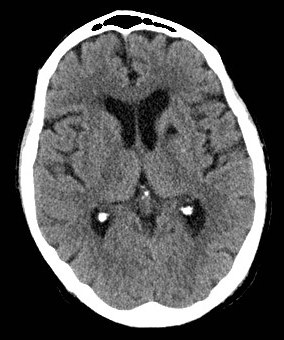 Lacunar infarct example