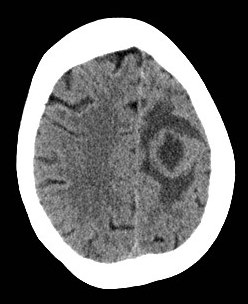 Primary brain tumour imaging