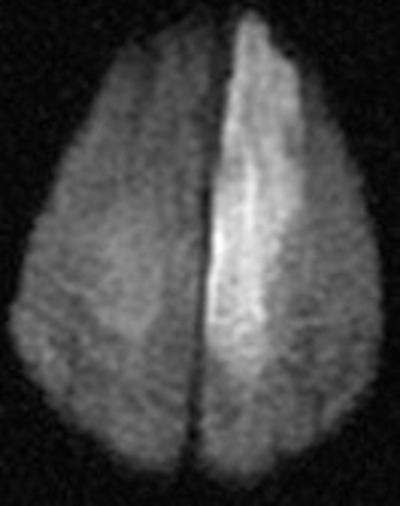 ACA infarct imaging example
