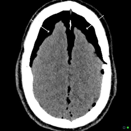 CT head showing intracranial air