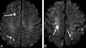 Air embolism vascular pattern