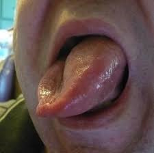 Orolingual angioedema after alteplase