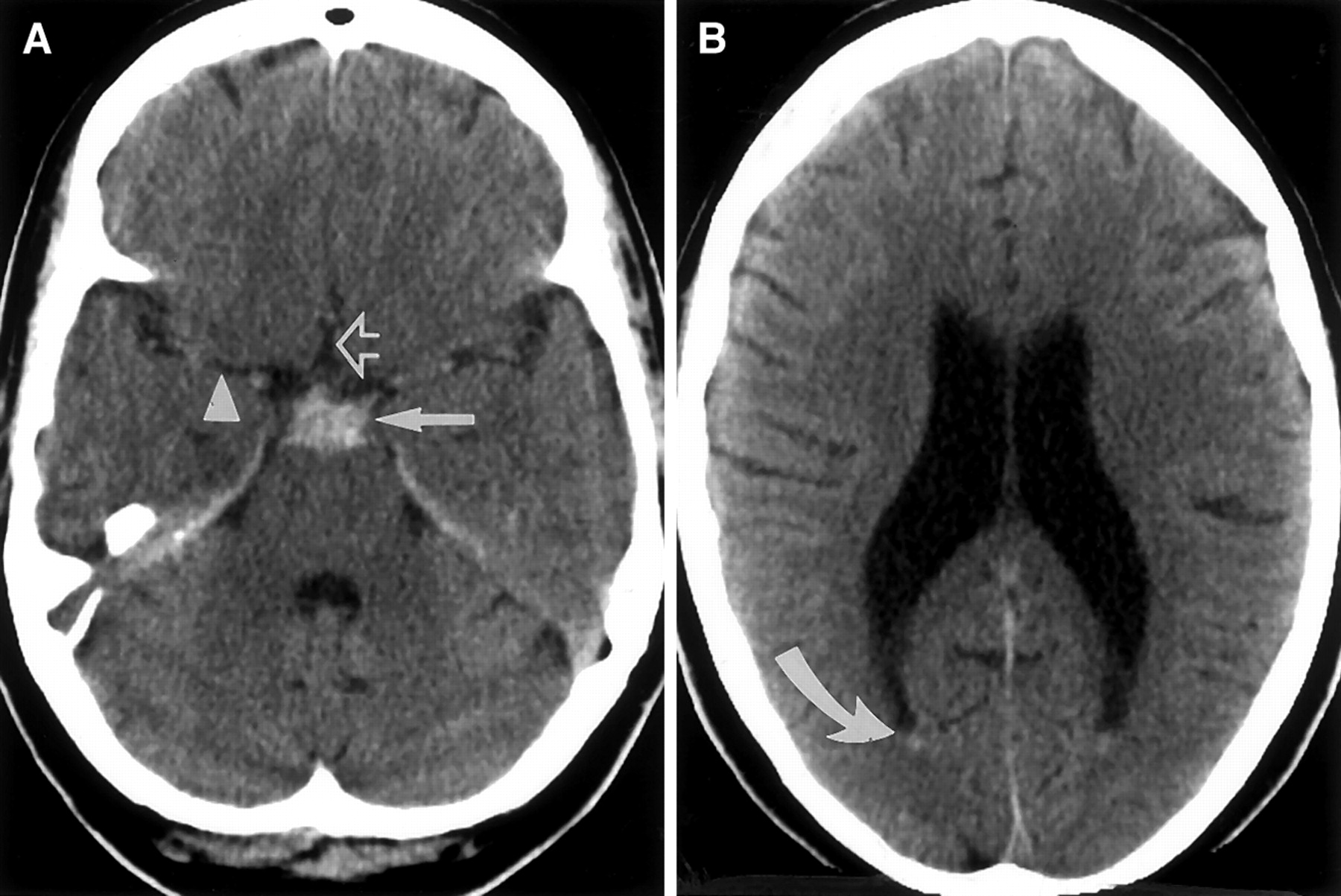 Perimesencephalic SAH CT