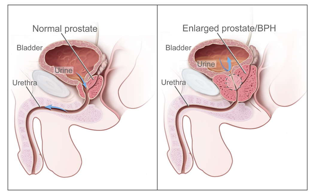 BPH diagram