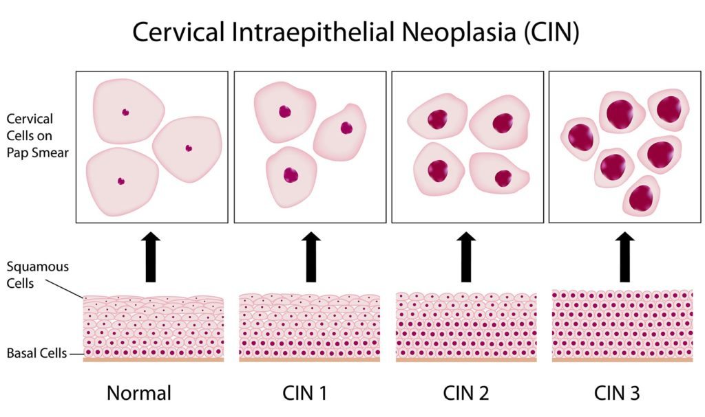 CIN Classification Image