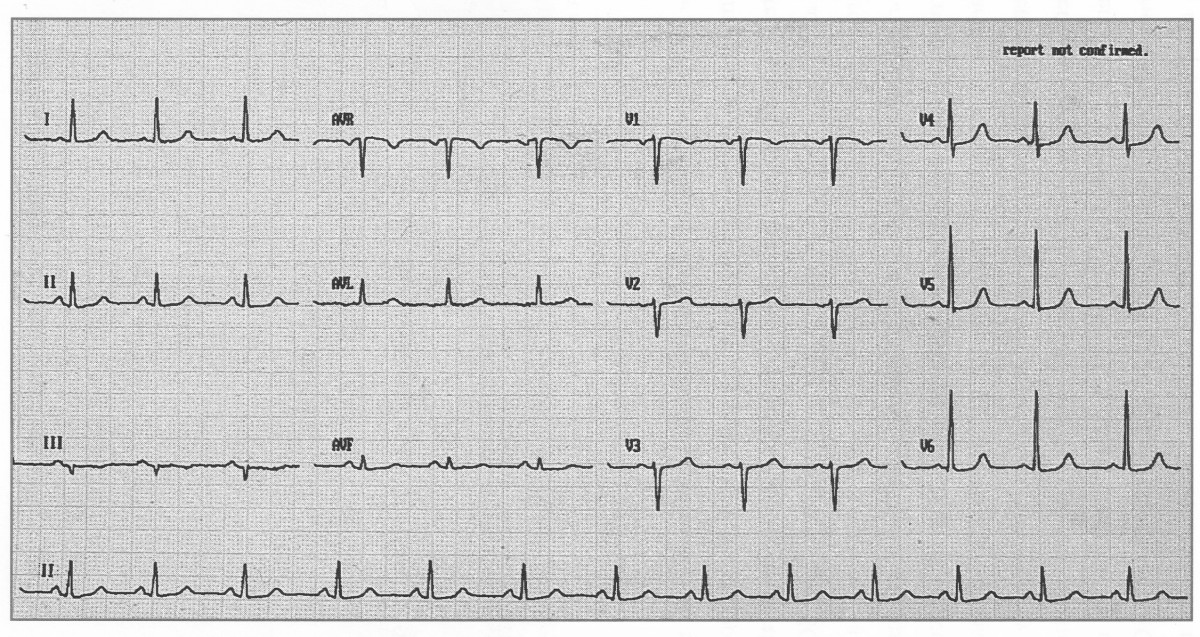 Normal ECG 3