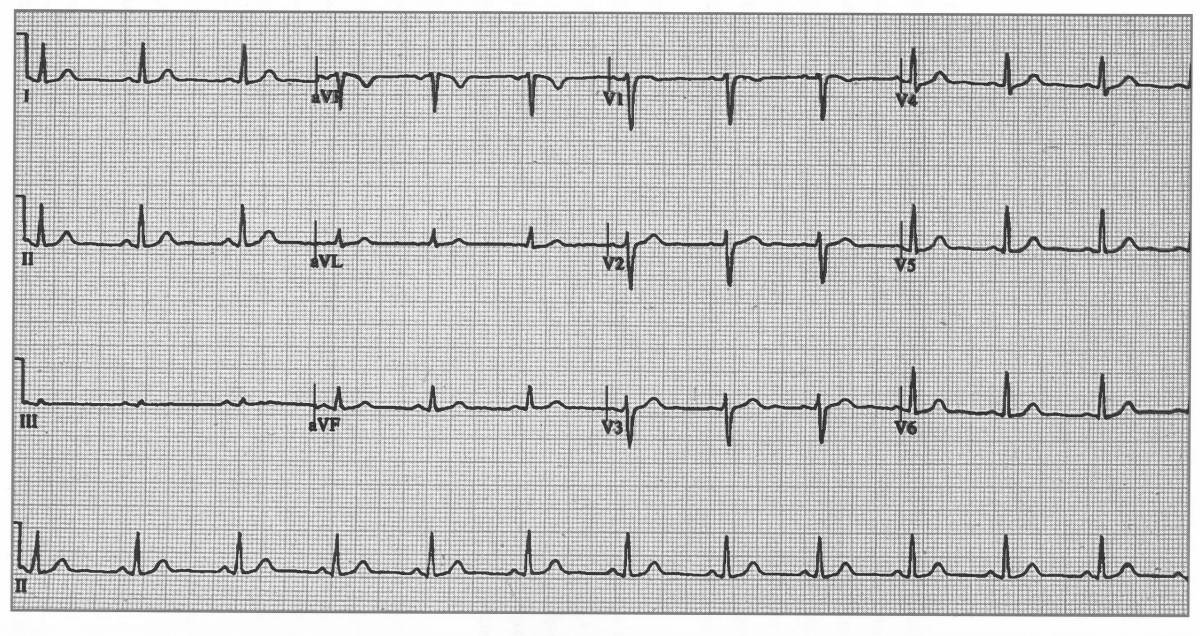 Normal ECG 4