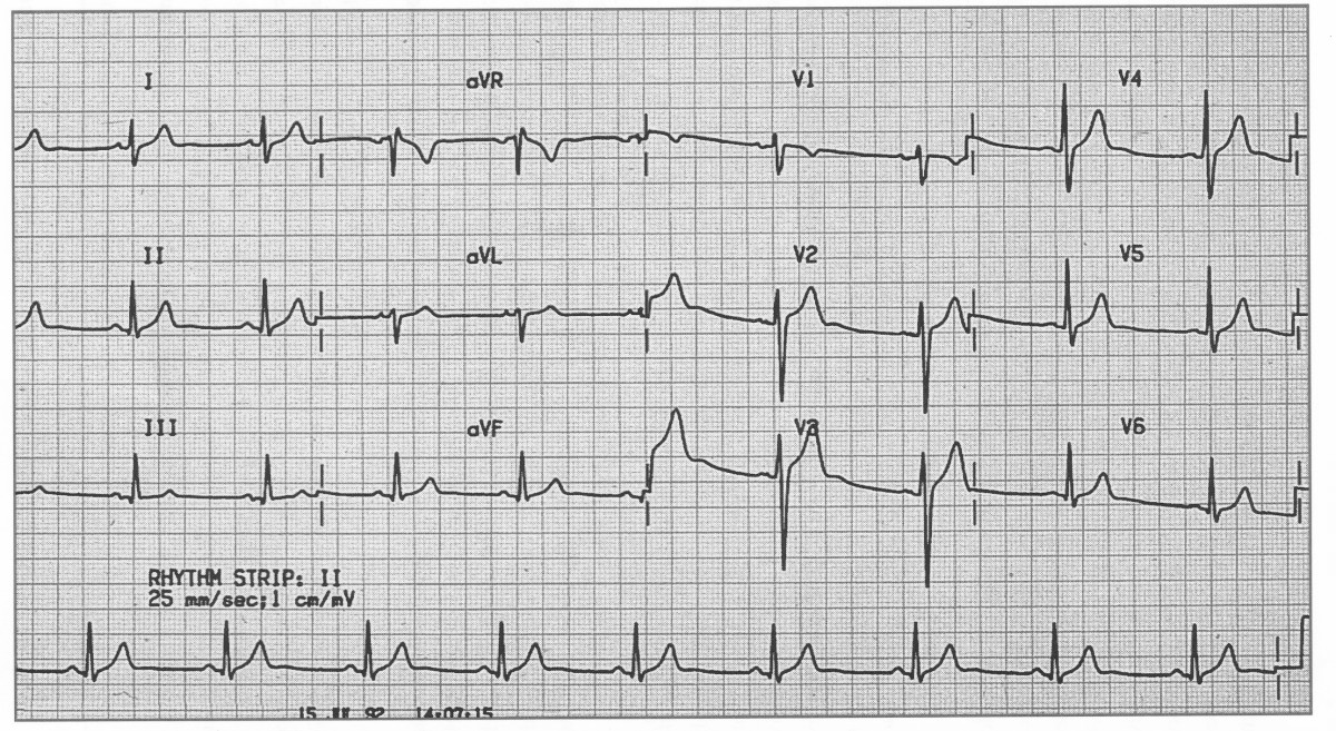 Normal ECG 5