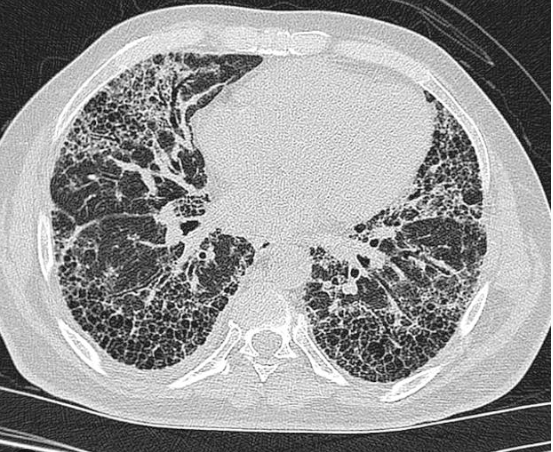 IPF honeycomb lung