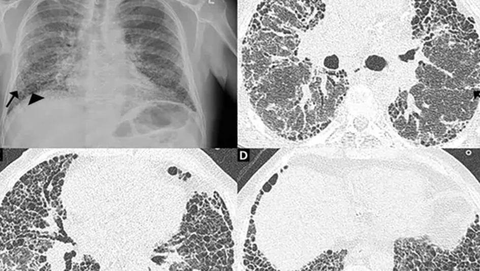 IPF HRCT