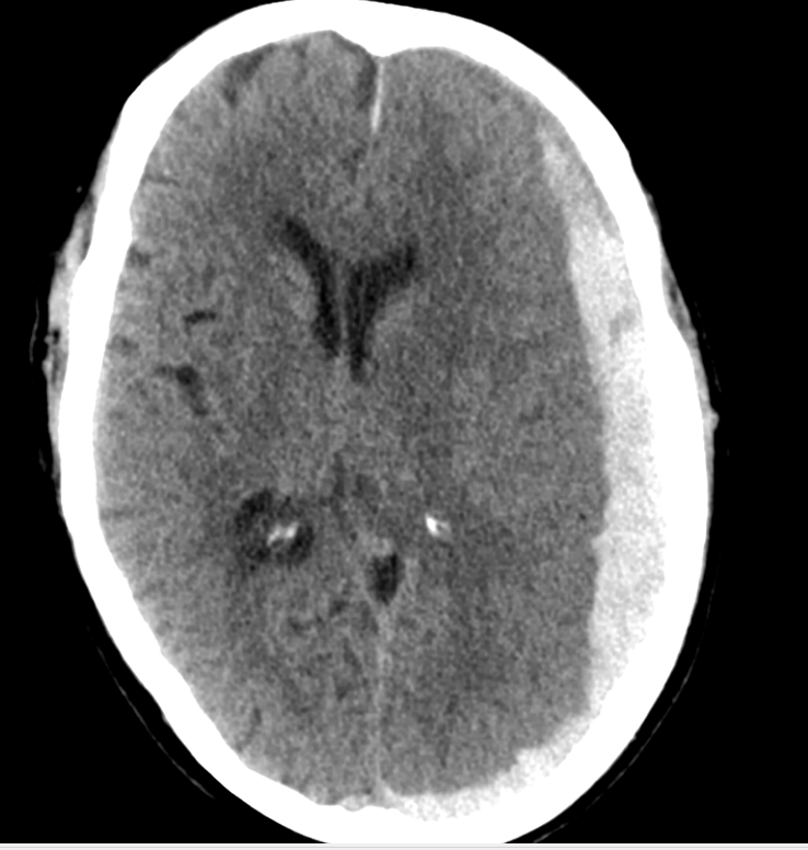 Large acute subdural haematoma on CT scan