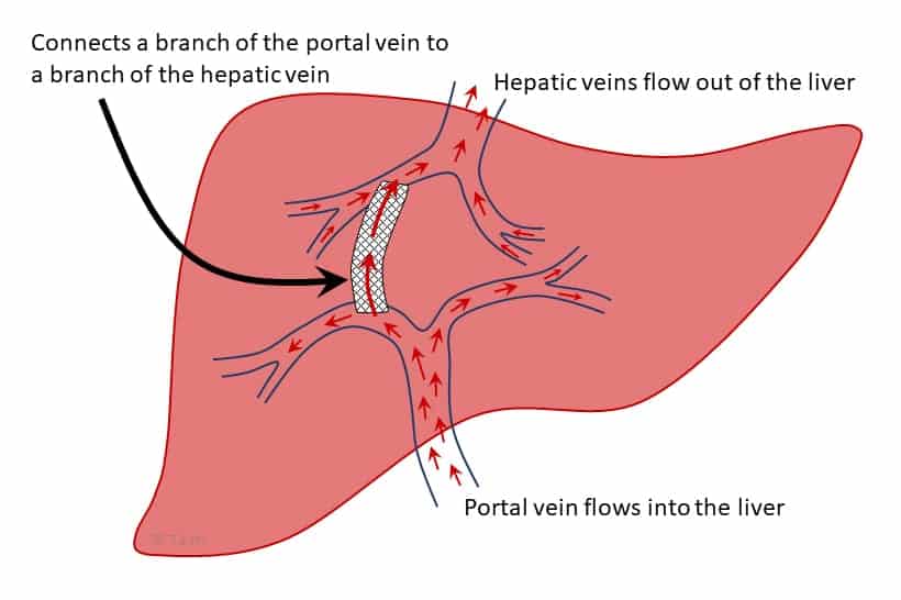 TIPS diagram