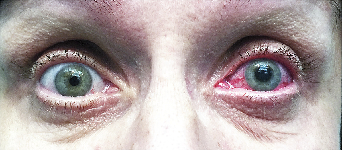 Clinical appearance of AACG