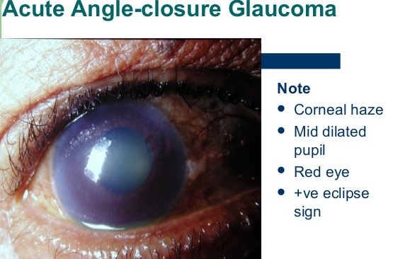 Corneal haze in AACG