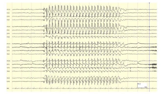 EEG 3Hz spike and wave pattern