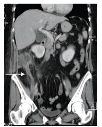 CT Scan Appendicitis