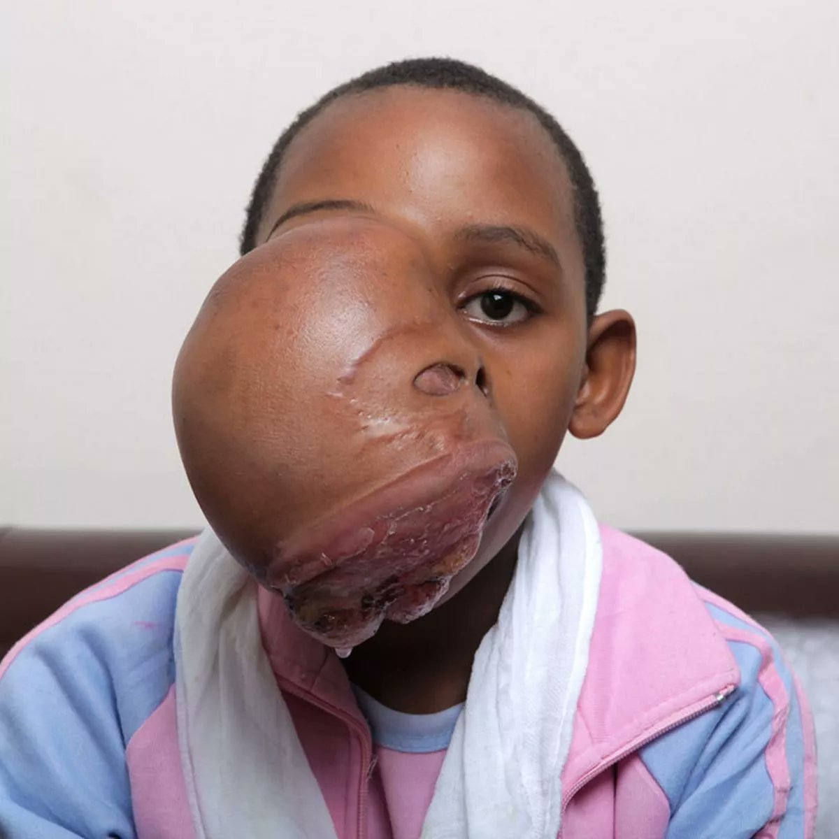 Ameloblastoma radiograph