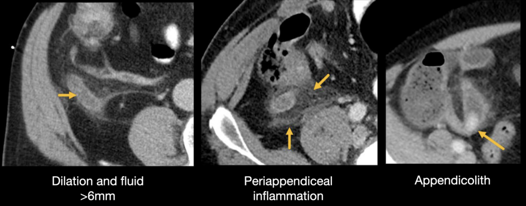 Appendicitis image