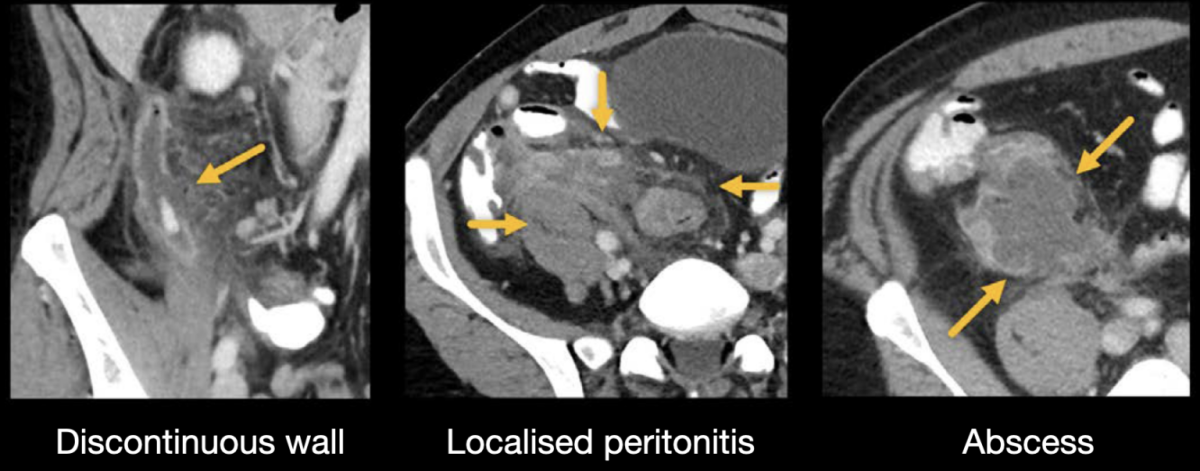 Appendicitis laparoscopic