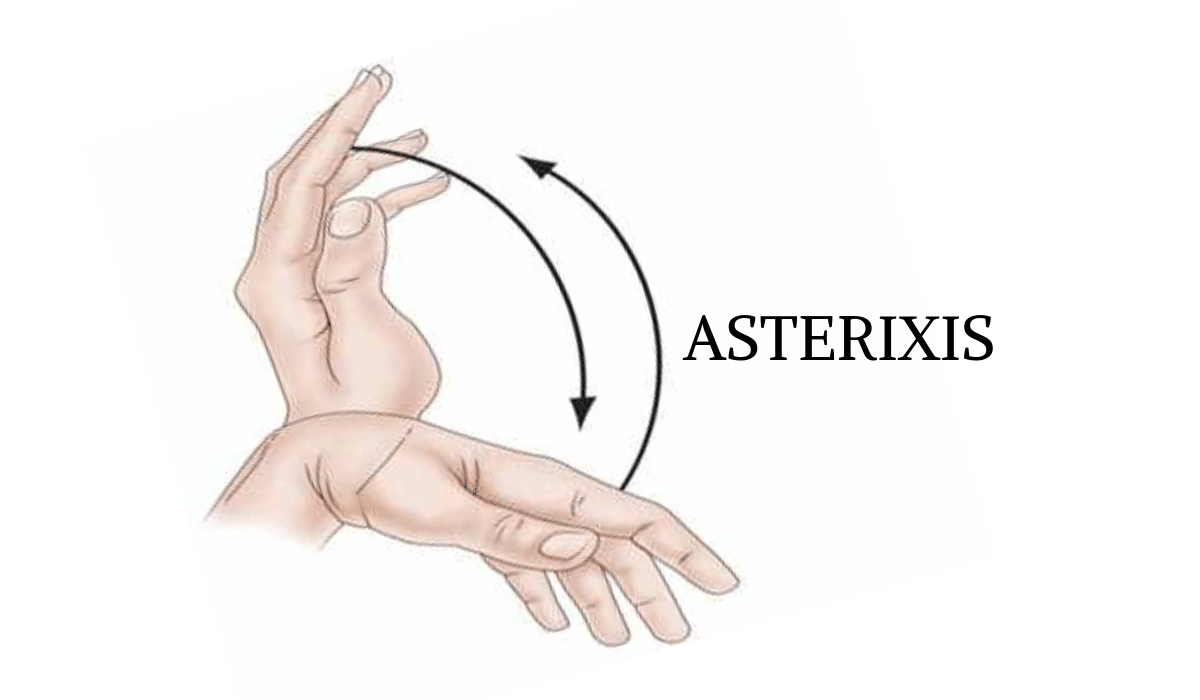Asterixis image