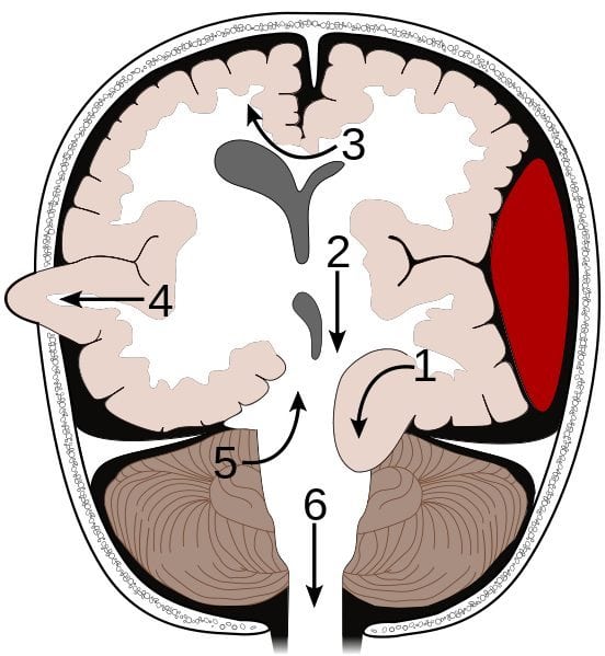 Brain herniation diagram