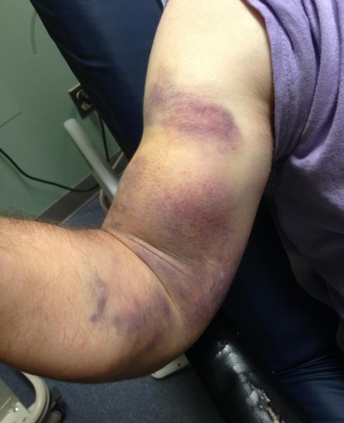 Biceps Rupture