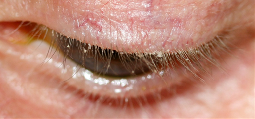 Blepharitis