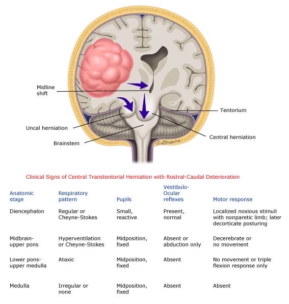 Brain herniation CT