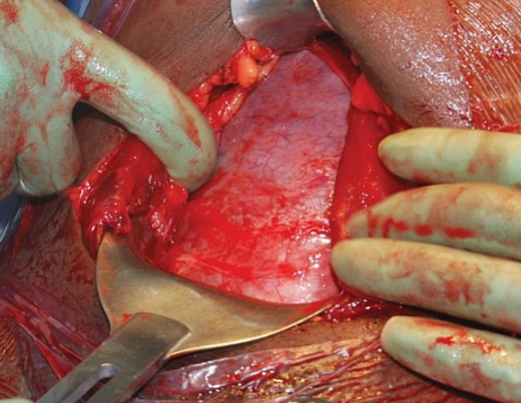 Caesarean Section