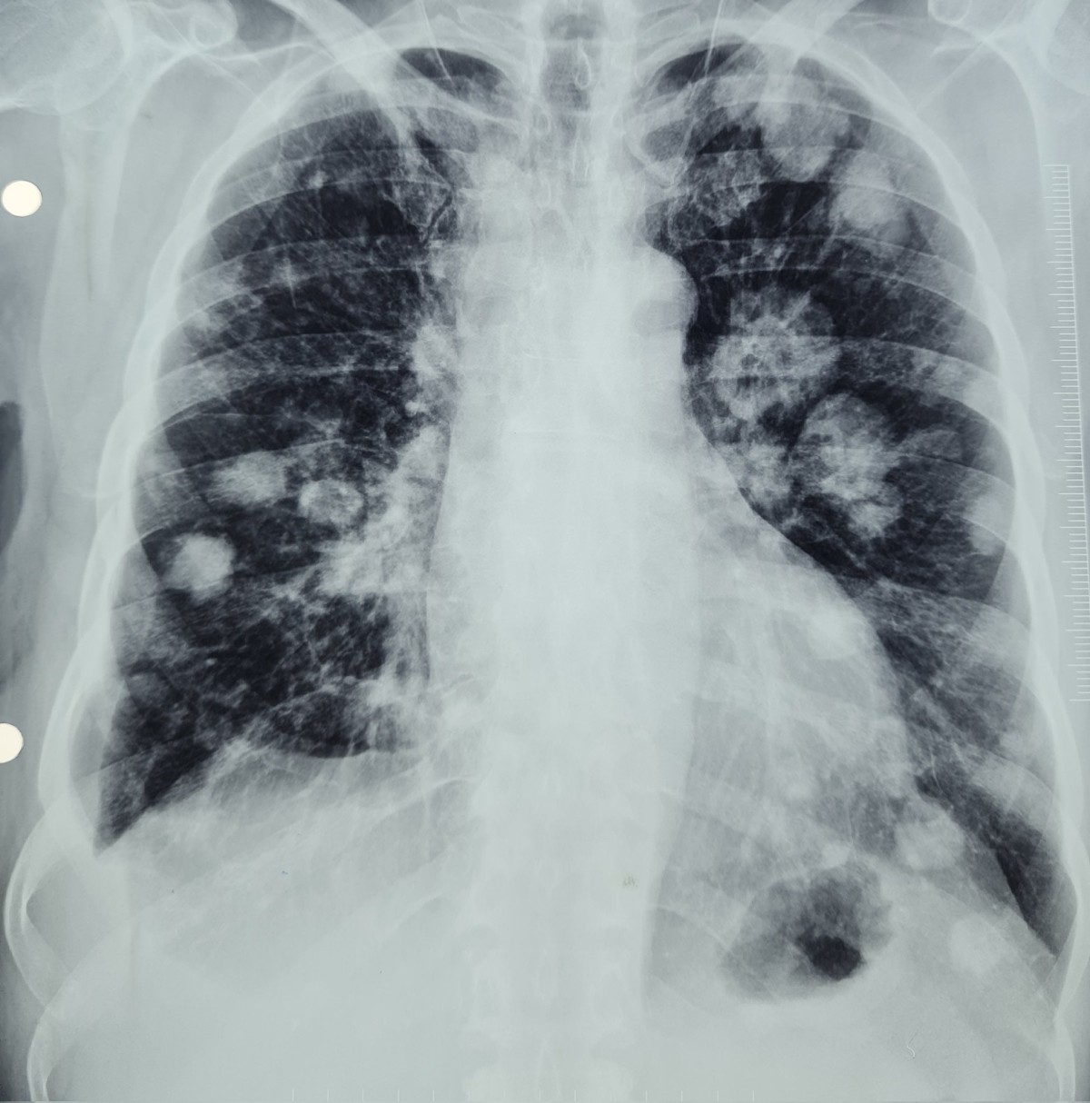 Cannonball metastases CT