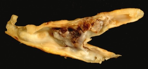 Carotid plaque