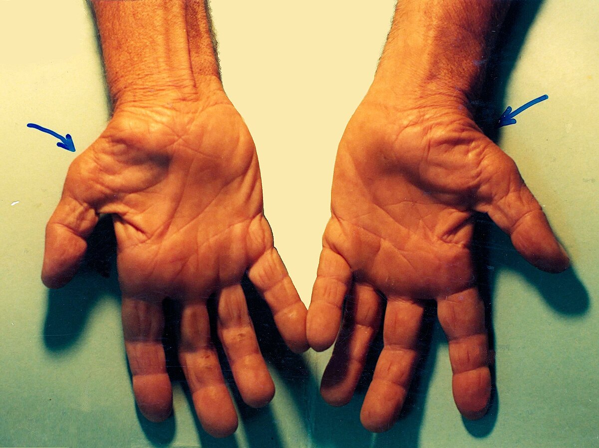 Clinical signs in CTS