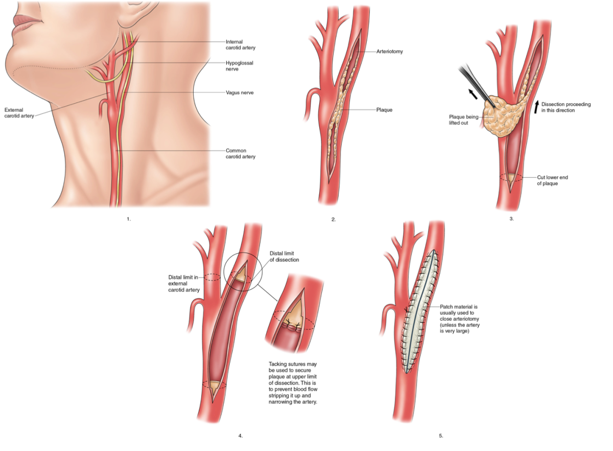 Carotid Endarterectomy Diagram