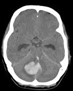 Cerebellar Haemorrhage CT