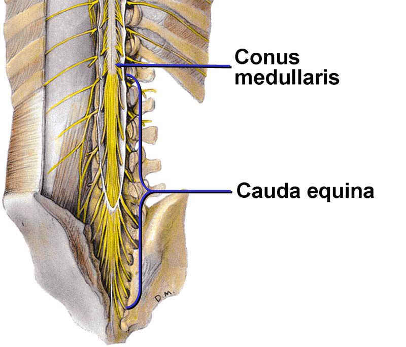 Conus Medullaris Syndrome