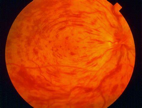 CRVO fundus image