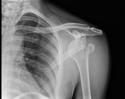 Anterior shoulder dislocation