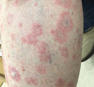 Drug-induced lupus rash