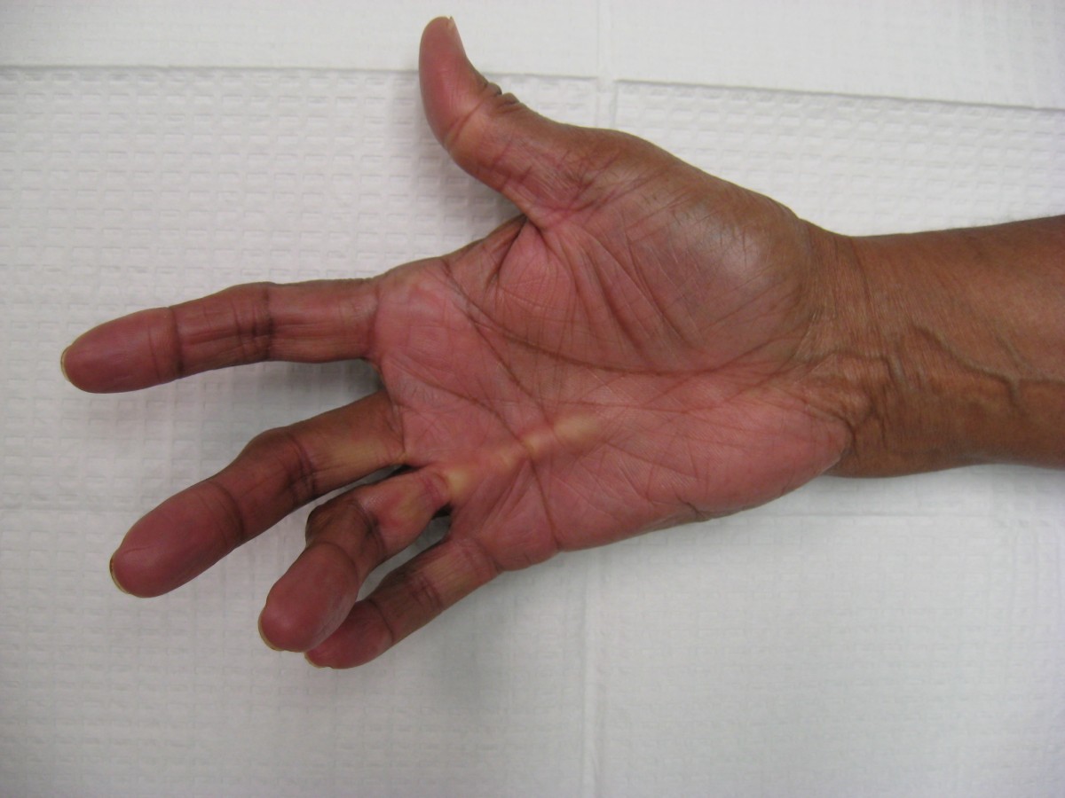 Dupuytren's contracture hand image