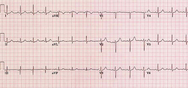 Normal ECG 6