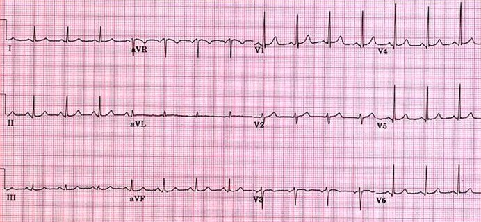 Normal ECG 7